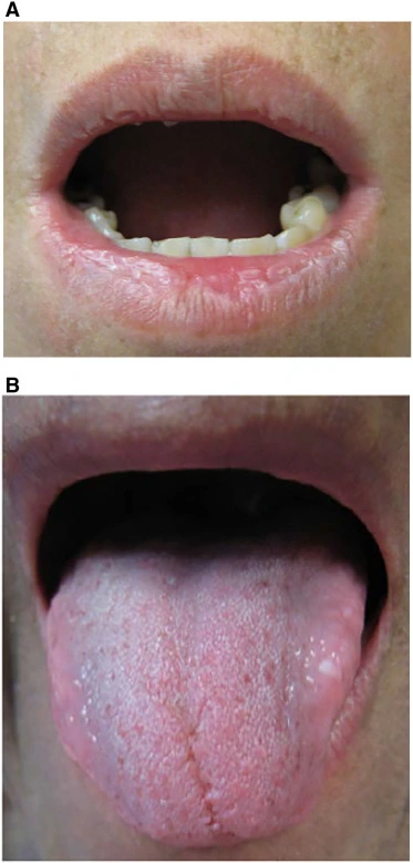 xerostomia