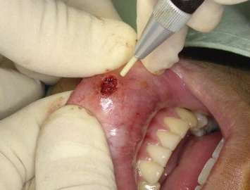 mukokel rongga mulut