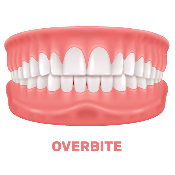 overbite