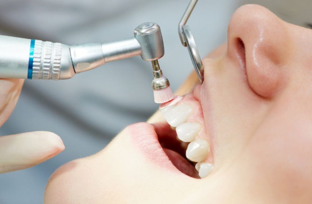 pembersihan gigi dengan oral profilaksis