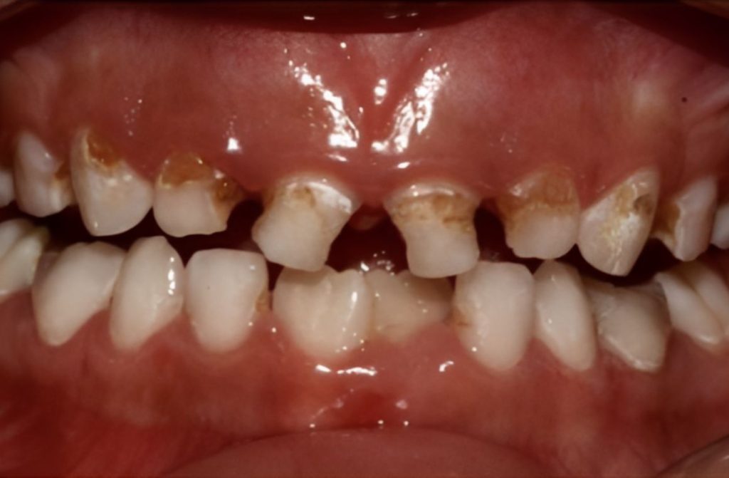 Perawatan gigi anak yang grepes atau hitam