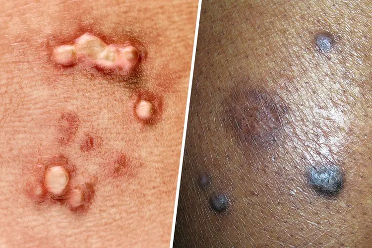 vaksin hpv