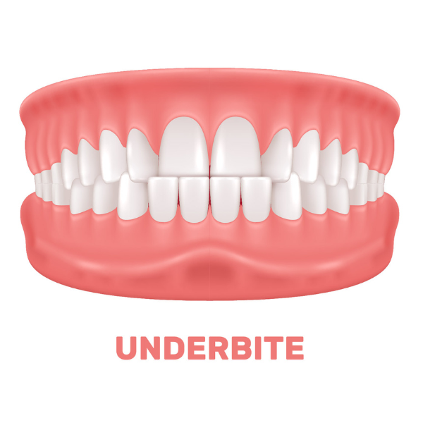 underbite