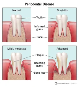 penyakit periodontal