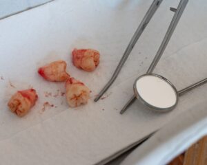 Operasi gigi bungsu
