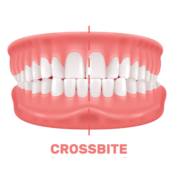 crossbite