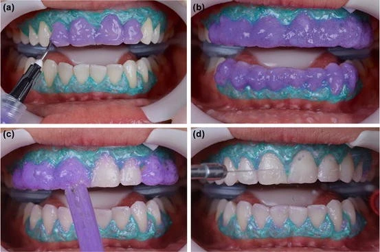 Langkah-langkah perawatan in-house bleaching