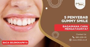 5 Penyebab Gummy Smile, Bagaimana Cara Mengatasinya?