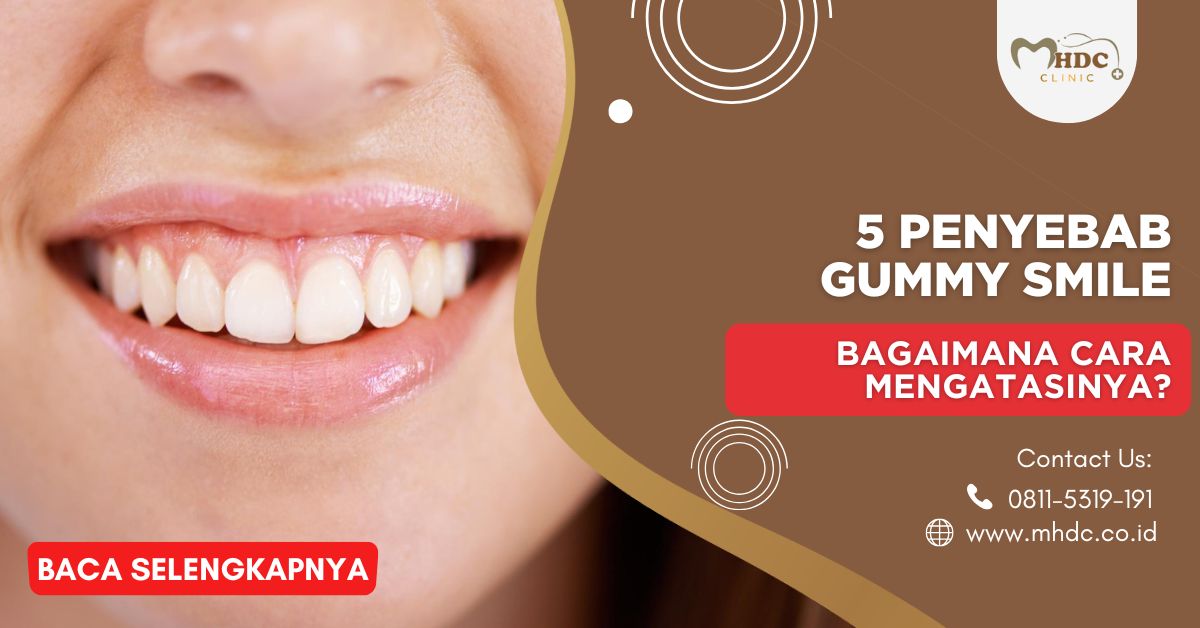 5 Penyebab Gummy Smile, Bagaimana Cara Mengatasinya?