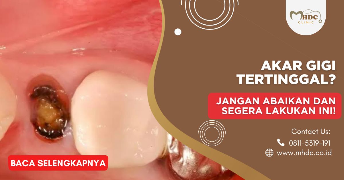 Akar Gigi Tertinggal? Jangan Abaikan dan Segera Lakukan Ini!