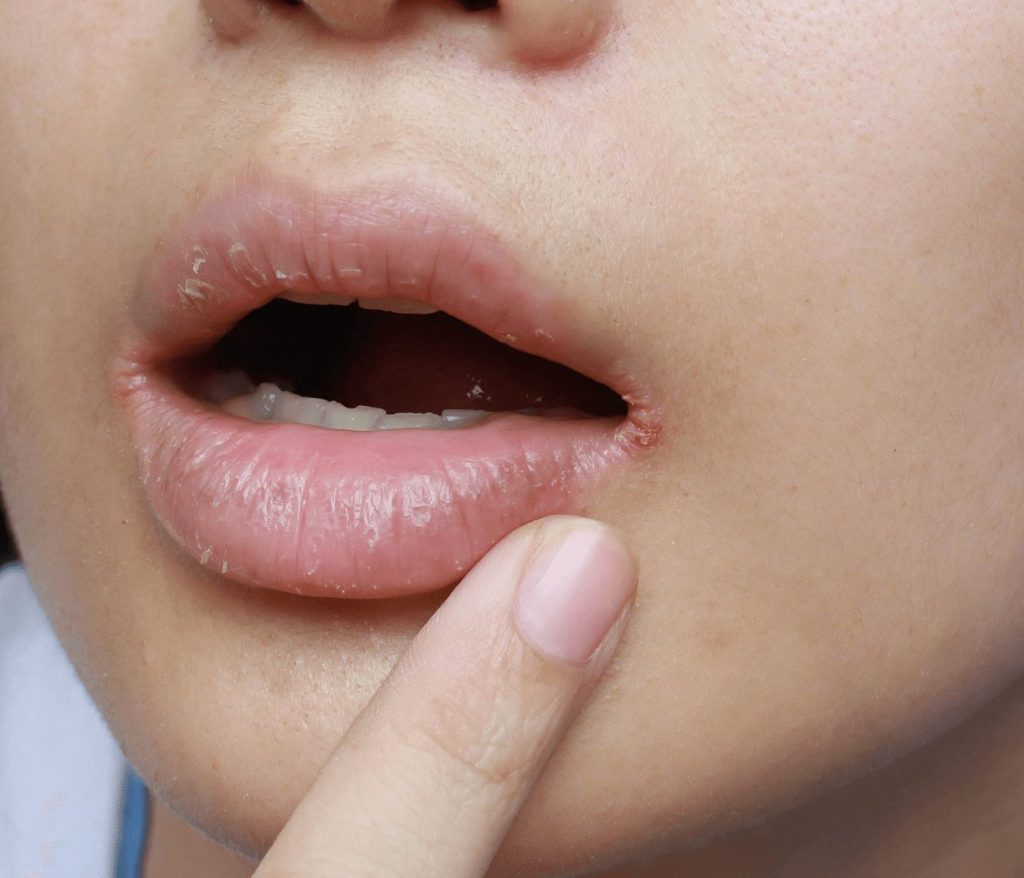 Angular cheilitis