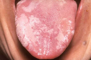 leukoplakia