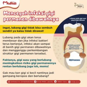 Bahaya gigi susu anak berlubang