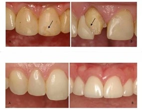 veneer gigi direct
