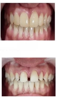 veneer gigi indirect