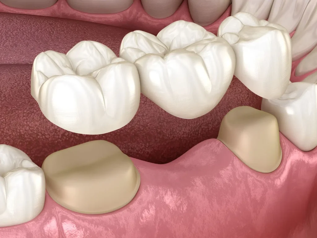 Implan gigi dan dental bridge sebagai alternatif perawatan gigi yang hilang