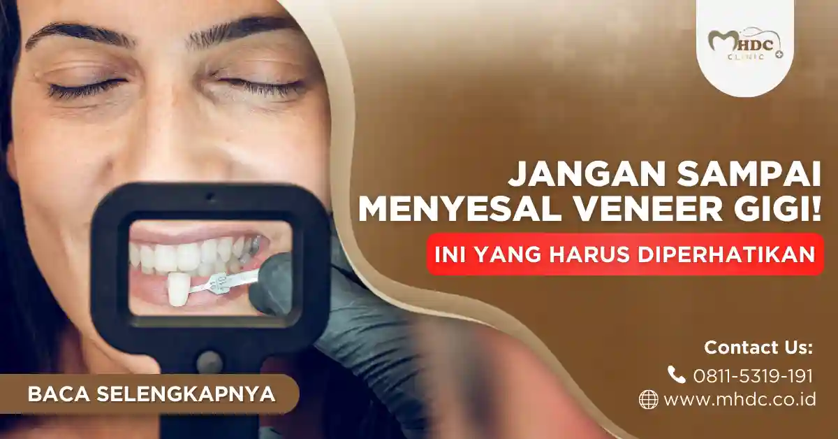 menyesal veneer gigi