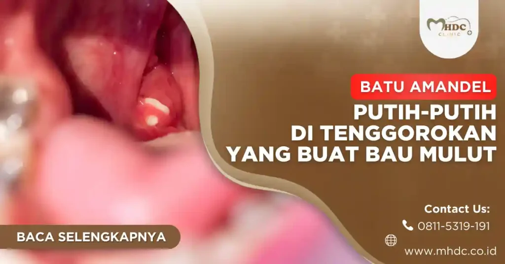 putih putih di tenggorokan