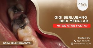 gigi berlubang bisa menular