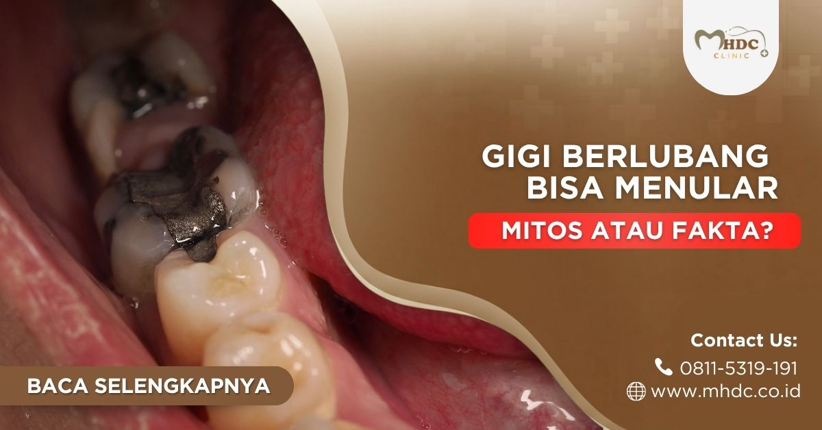gigi berlubang bisa menular