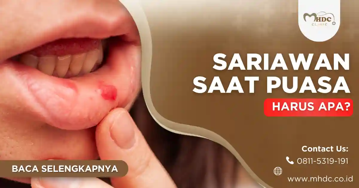 sariawan saat puasa
