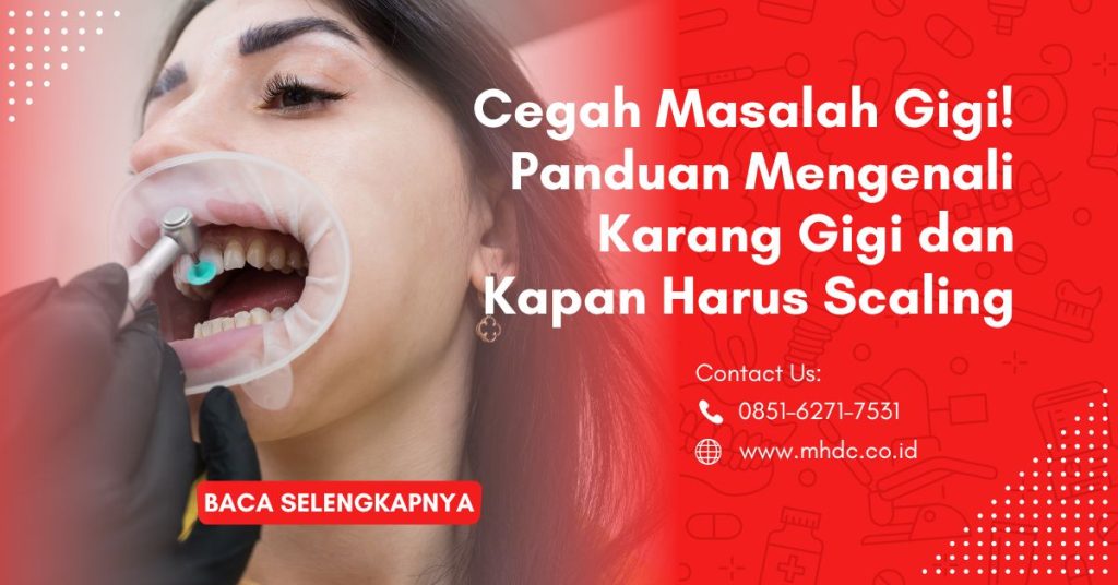 Panduan Mengenali Karang Gigi dan Kapan Harus Scaling