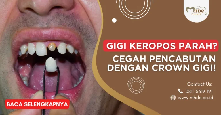 Gigi Keropos Parah? Cegah Pencabutan dengan Crown Gigi!