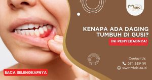 Kenapa Ada Daging Tumbuh di Gusi? Ini Penyebabnya!
