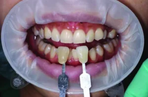 harga bleaching gigi