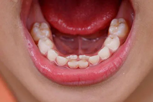 Gigi susu belum copot padahal gigi baru sudah muncul