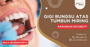 Gigi Bungsu Atas Tumbuh Miring, Haruskah Dicabut?