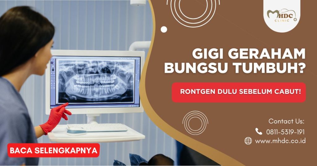 Gigi Geraham Bungsu Tumbuh? Rontgen Dulu Sebelum Cabut!