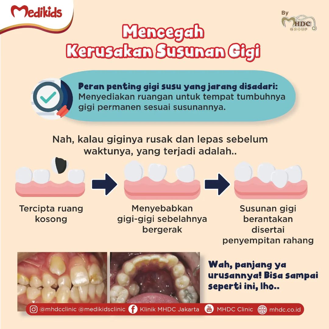 Gigi Susu Anak Berlubang, Harus Ditambal Atau Tunggu Ganti?