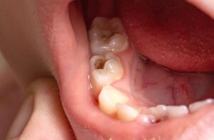perawatan sakit gigi berlubang dengan penambalan