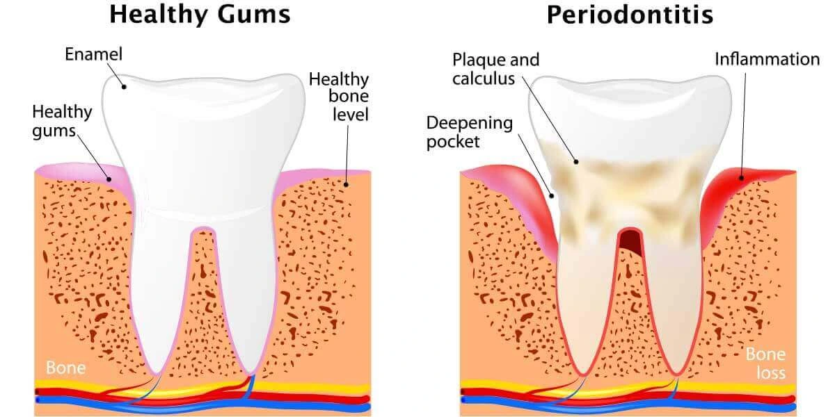 gingivitis