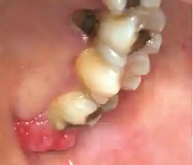 ciri ciri tumor gusi