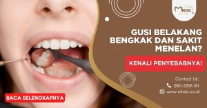 Gusi Belakang Bengkak dan Sakit Menelan Kenali Penyebabnya!