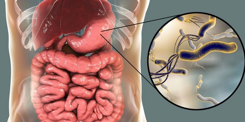 Infeksi helicobacter pylori pada lambung