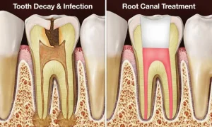 ilustrasi sebelum dan setelah perawatan akar gigi