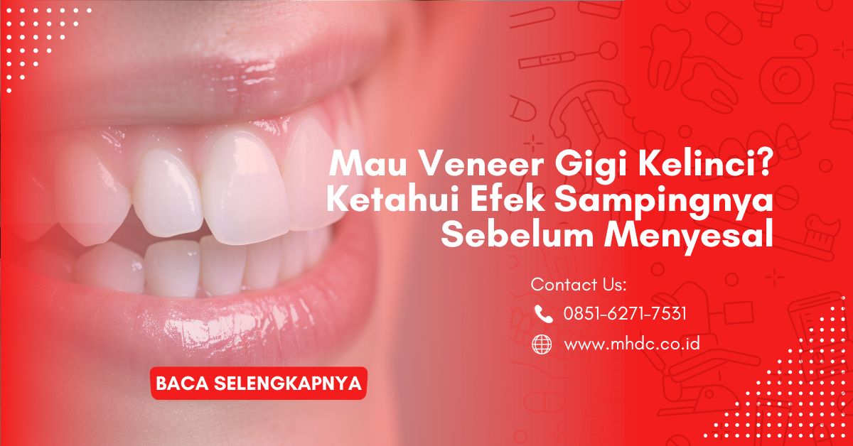 Mau Veneer Gigi Kelinci? Ketahui Efek Sampingnya Sebelum Menyesal