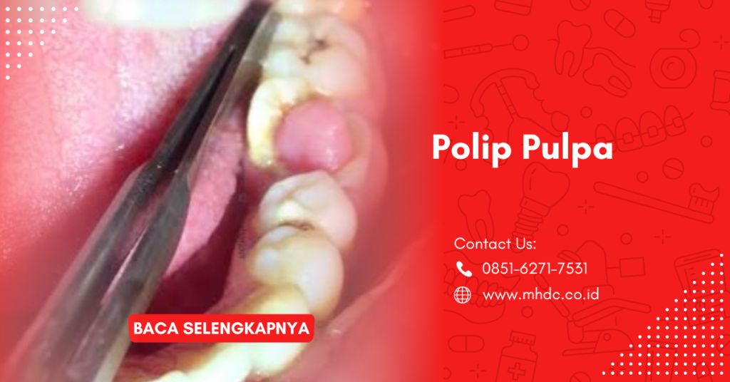 Polip Pulpa Gigi, Kenapa Ada Daging Tumbuh di Gigi?