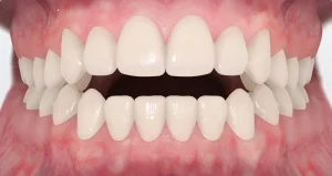 open bite teeth