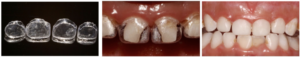 Perawatan gigi depan gigis