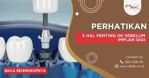 Perhatikan 5 Hal Penting Ini Sebelum Implan Gigi!