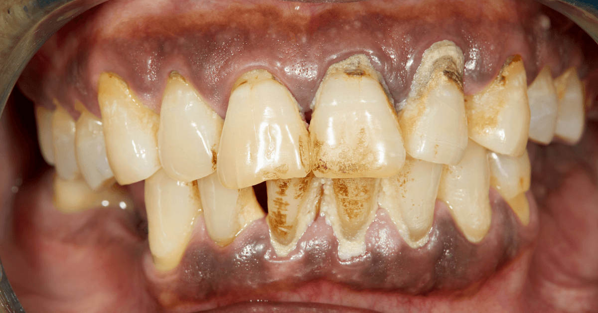 periodonsia adalah