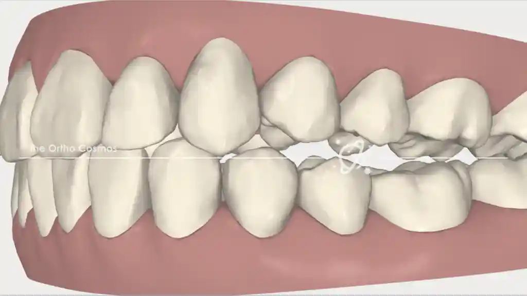 behel open bite