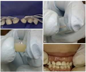 Perawatan Celluloid Crown untuk gigi gigis