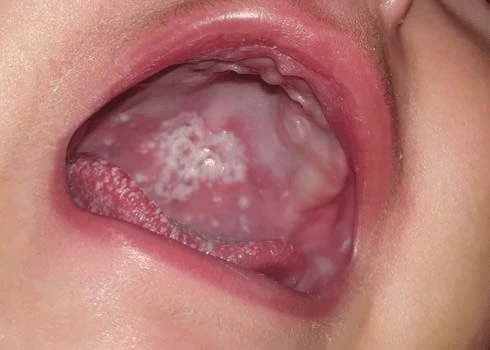 Oral thrush