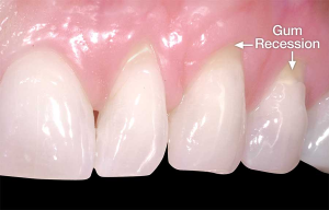 Resesi gingiva