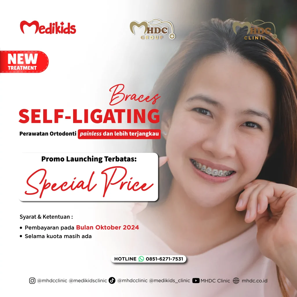 promo self ligating mhdc